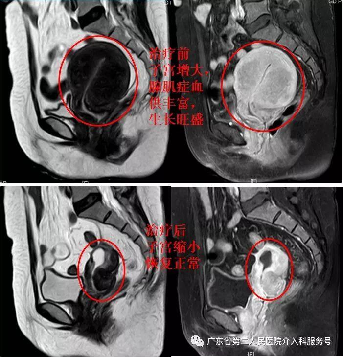 子宫腺肌症的最新疗法：子宫腺肌症治疗新进展